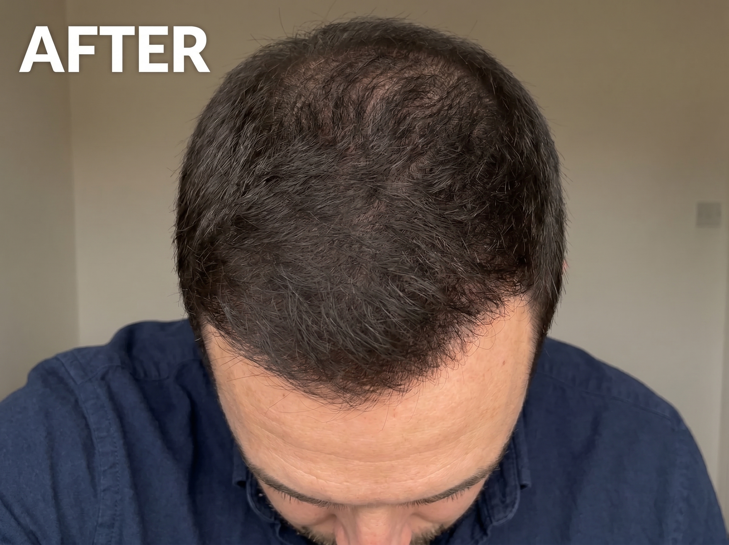 After 90 days of LumiScalp use